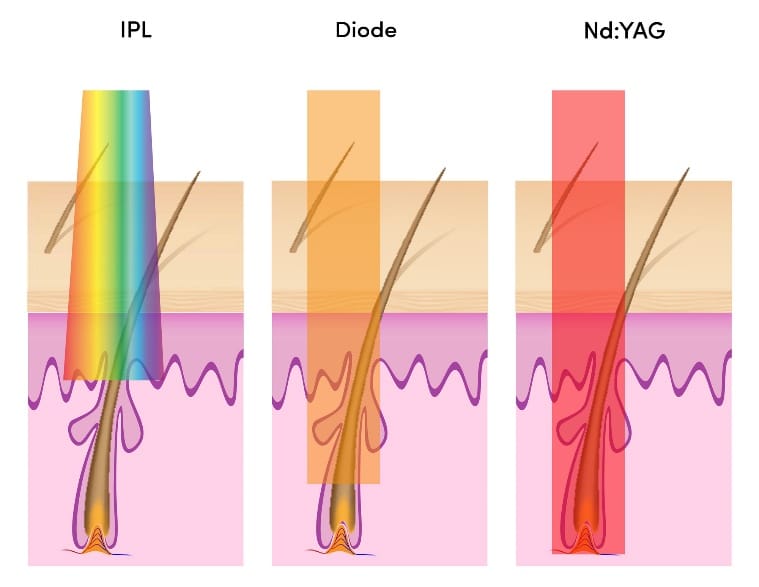 candela laser vs ipl