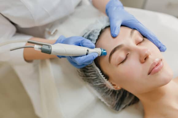 What will micro needling do to my face?